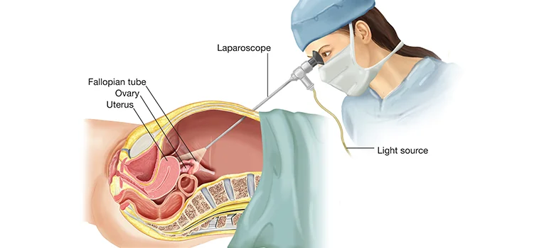 Laparoscopic surgery procedure for gynecological treatment at Malti Hospital & Test Tube Baby Centre in Bhopal